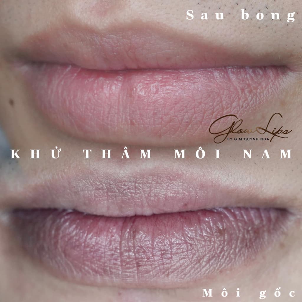 khử thâm môi nam hiêu quả